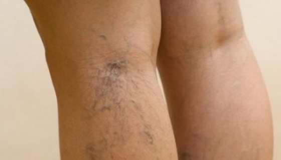 Cum recunosc boala venoasă cronică?