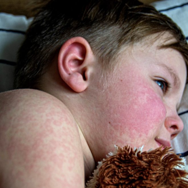 Ce este rujeola (pojarul) si cum se trateaza?