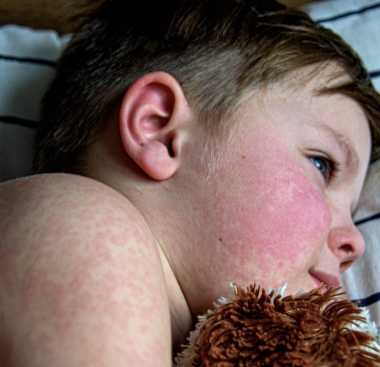 Ce este rujeola (pojarul) si cum se trateaza?