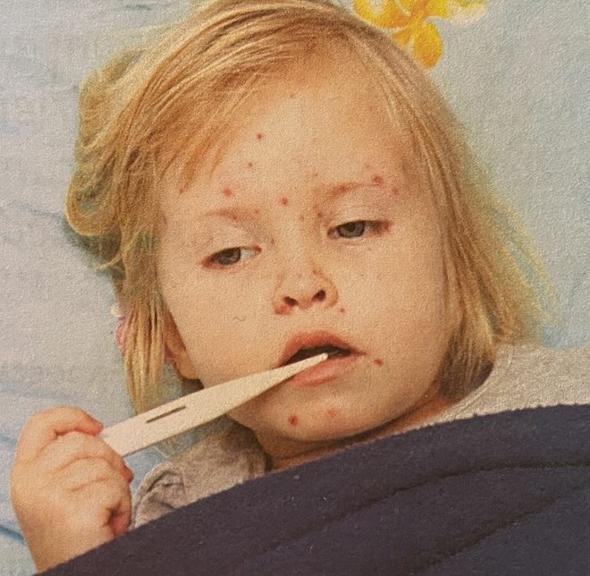 Cum se tratează rujeola (pojarul) la copii?