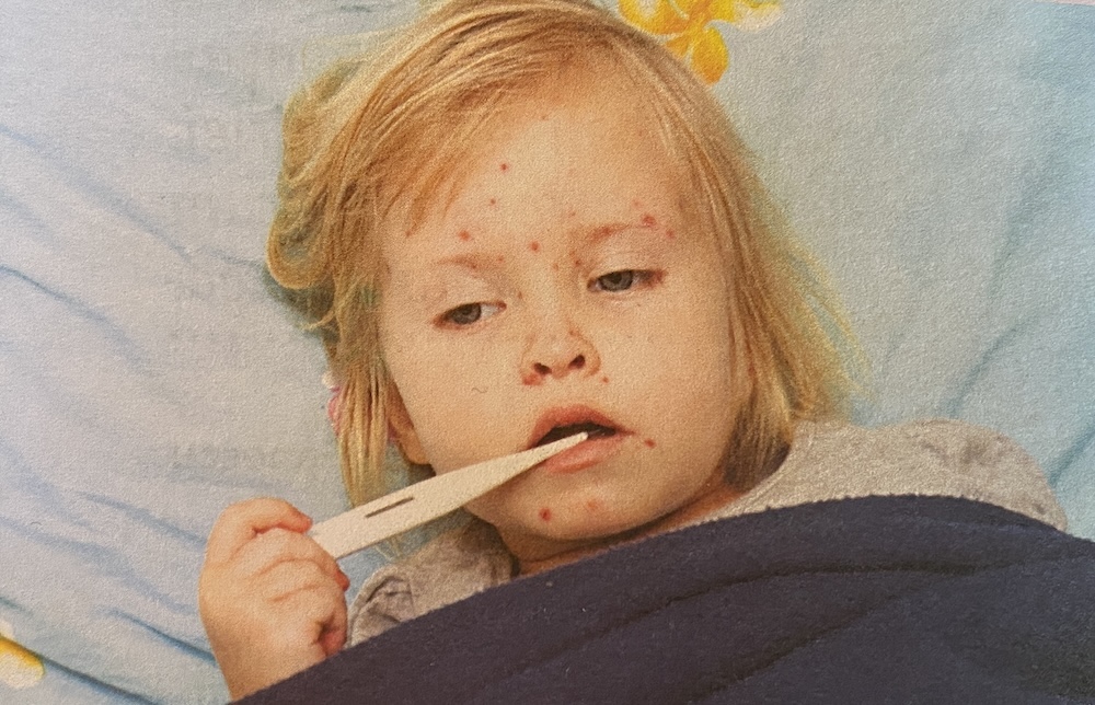 rujeola tratament copil