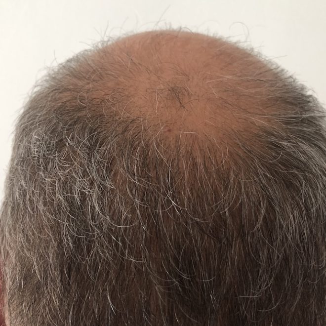 La ce doctor să mă duc dacă îmi cade părul?