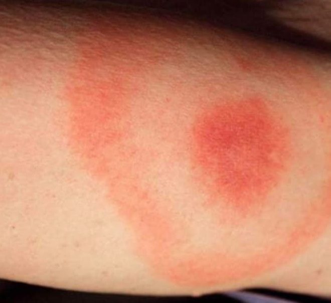 Boala Lyme: care sunt semnele și cum se pune diagnosticul