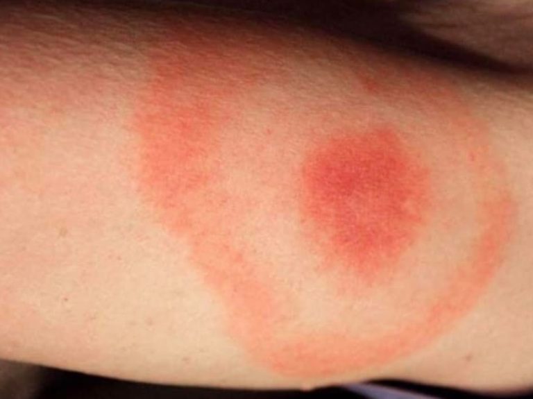 Boala Lyme: care sunt semnele și cum se pune diagnosticul